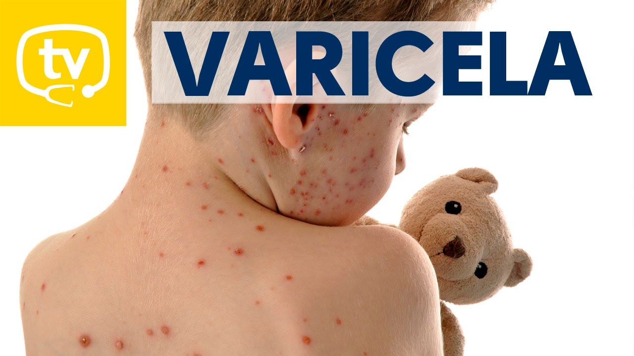 Varicela ¡todo lo que debes saber!