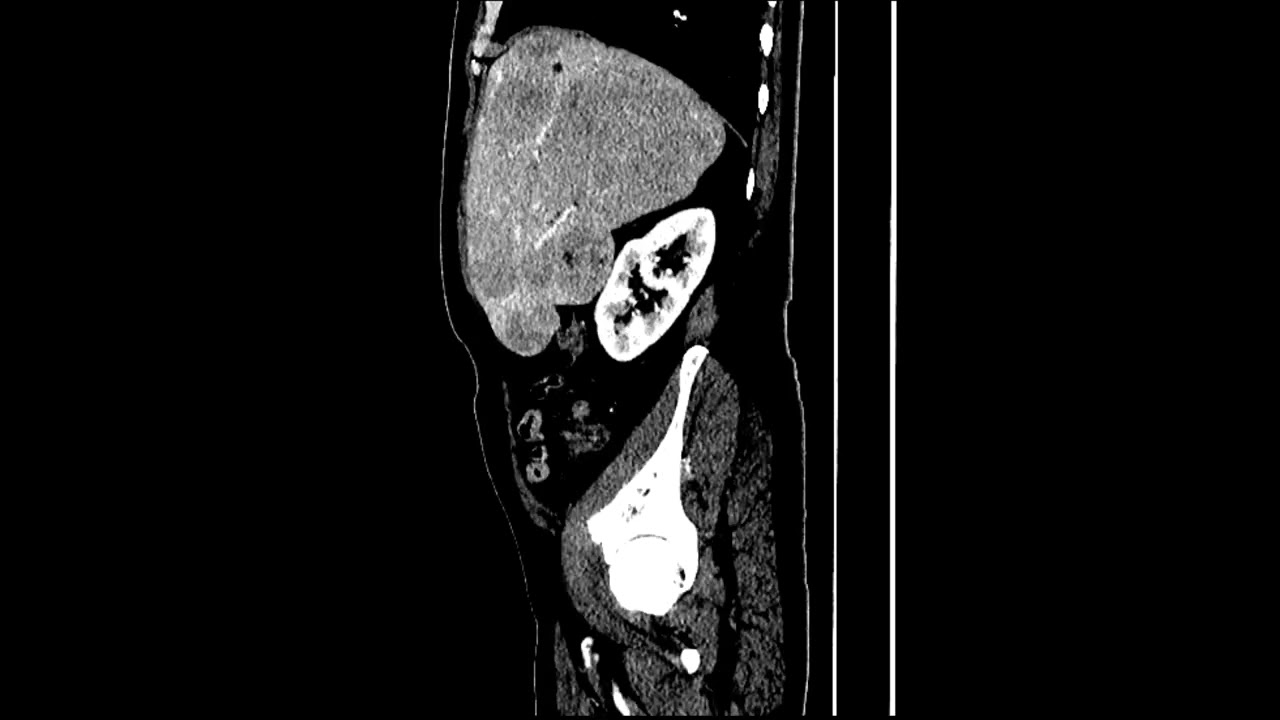 meta liver mass dt lung