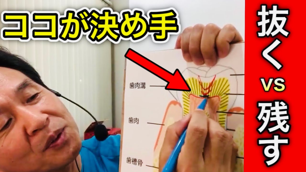 歯の神経は抜く？残す？歯医者がわかりやすく解説