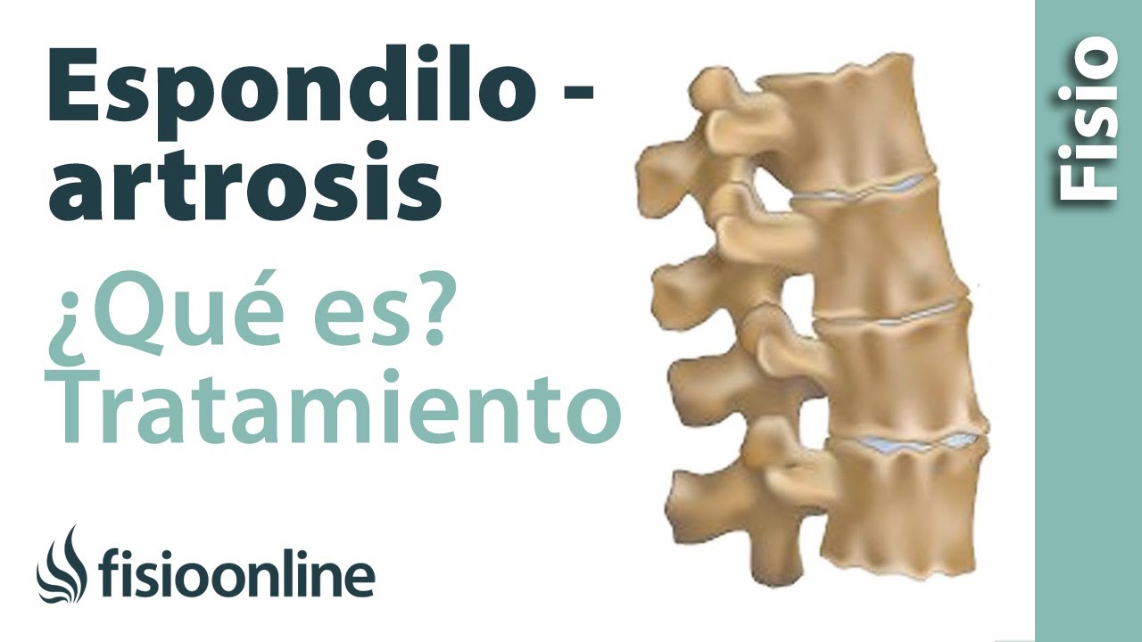 ¿Qué es la espondiloartrosis y cuál es su tratamiento?