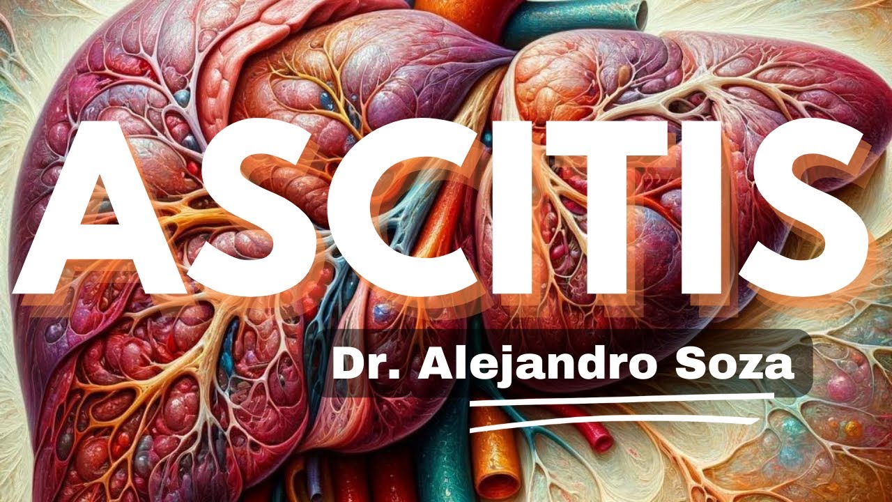 Ascitis: Diagnóstico y tratamiento - Lo que debe saber