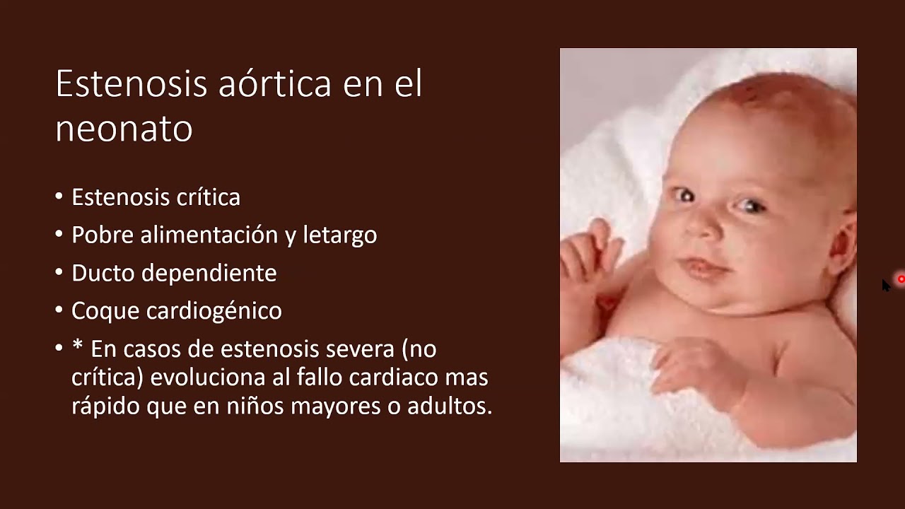Estenosis Aórtica