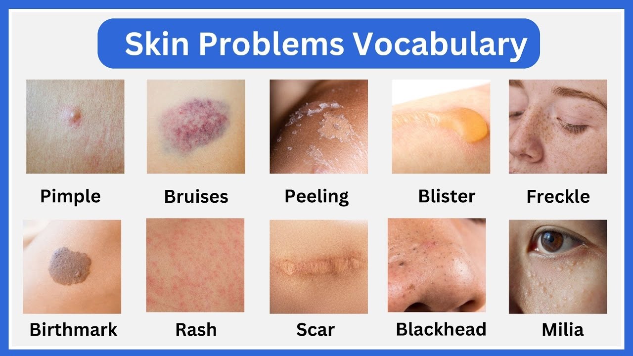 Common Skin Problems Vocabulary in English