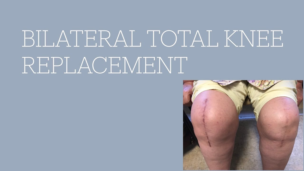 BILATERAL Total Knee Replacements - Good Idea? or Bad Decision?