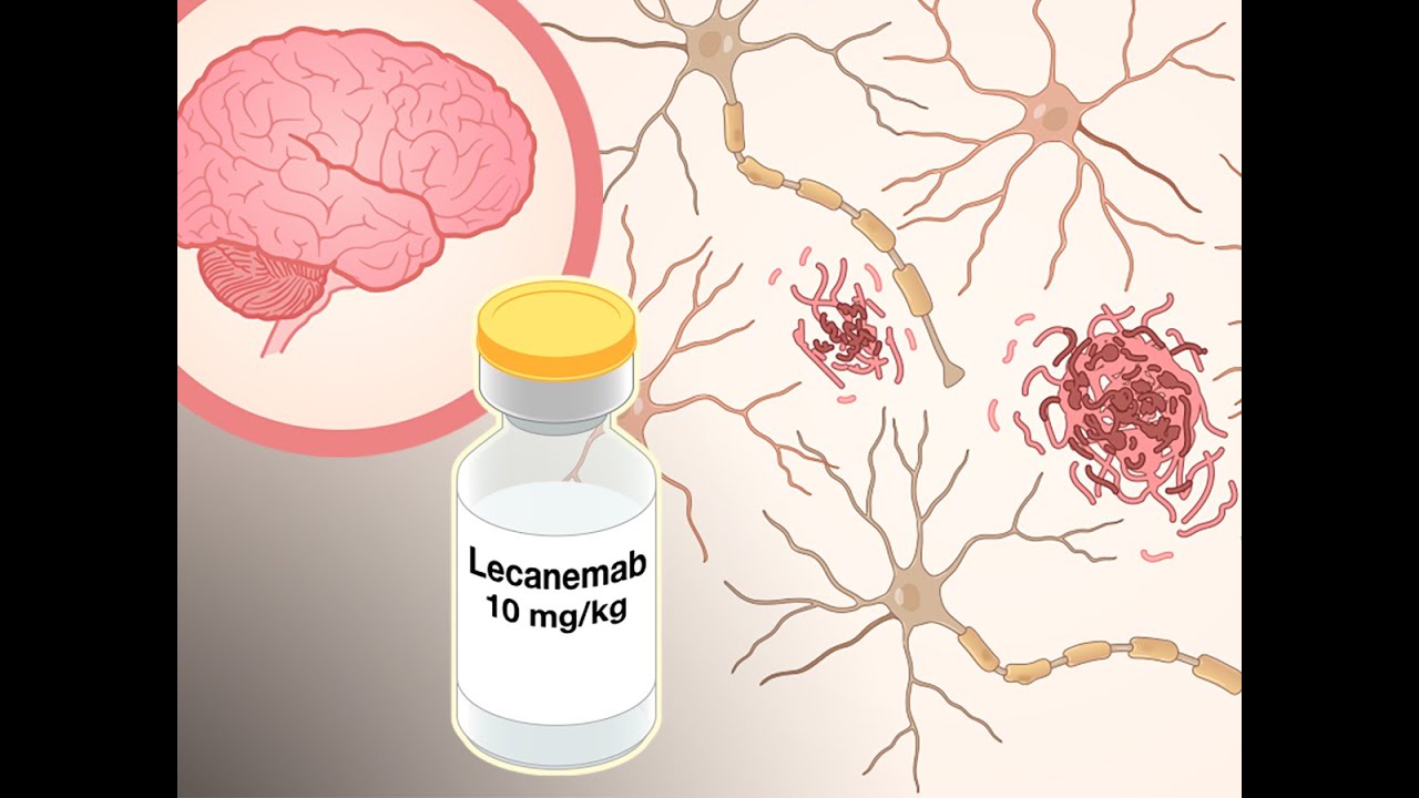 Lecanemab in Alzheimer&rsquo;s Disease | NEJM
