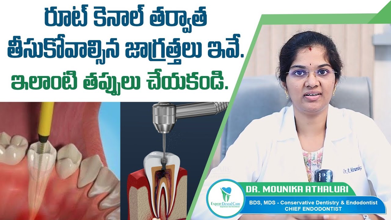 రూట్&zwnj; కెనాల్&zwnj; తర్వాత తీసుకోవాల్సిన జాగ్రత్తలు |Precautions to Take Post Root Canal |ExpertDentalCare