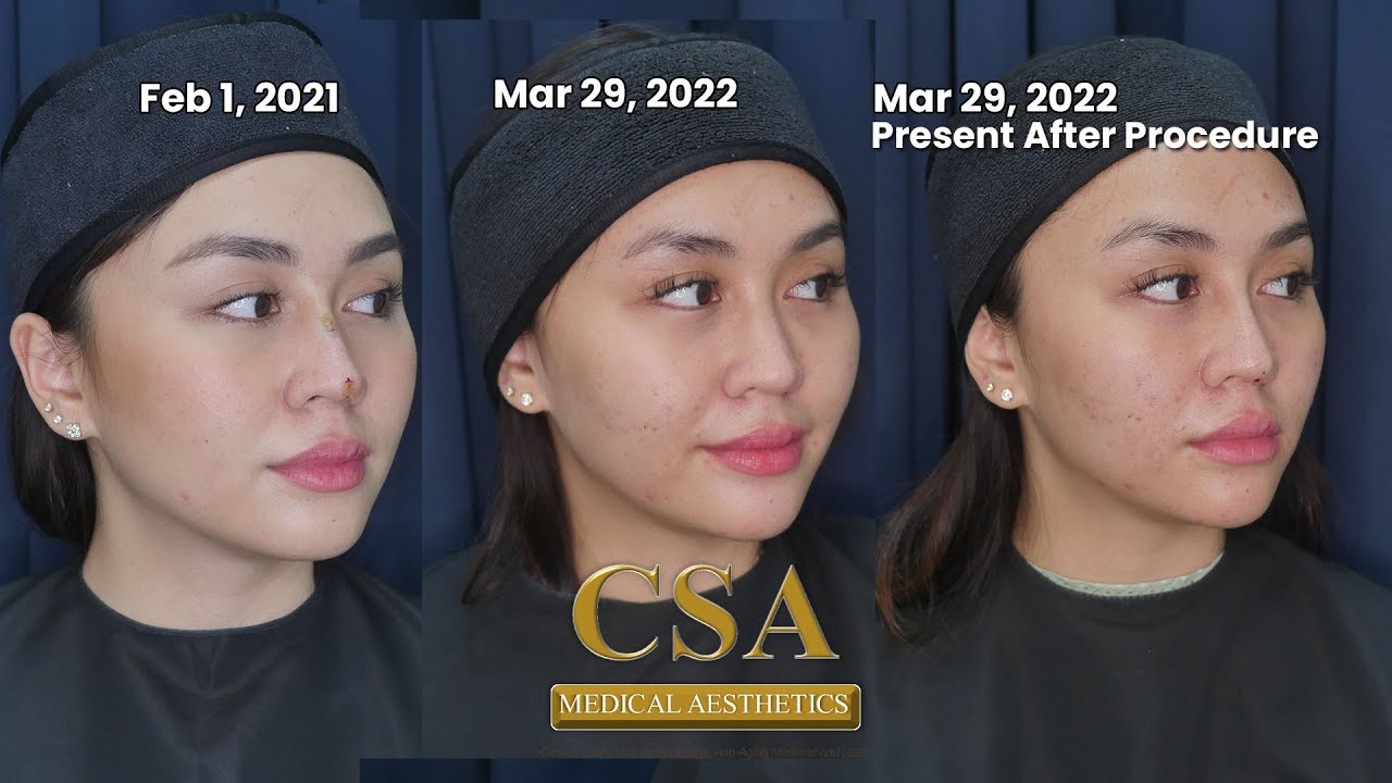 Hiko Booster: Repeat nonsurgical nose thread-lift