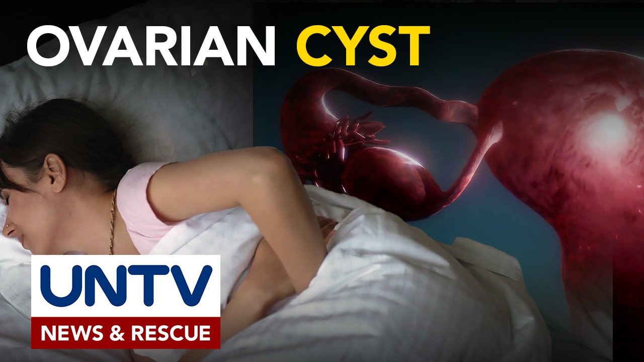 Ovarian cyst, maaaring walang sintomas sa umpisa