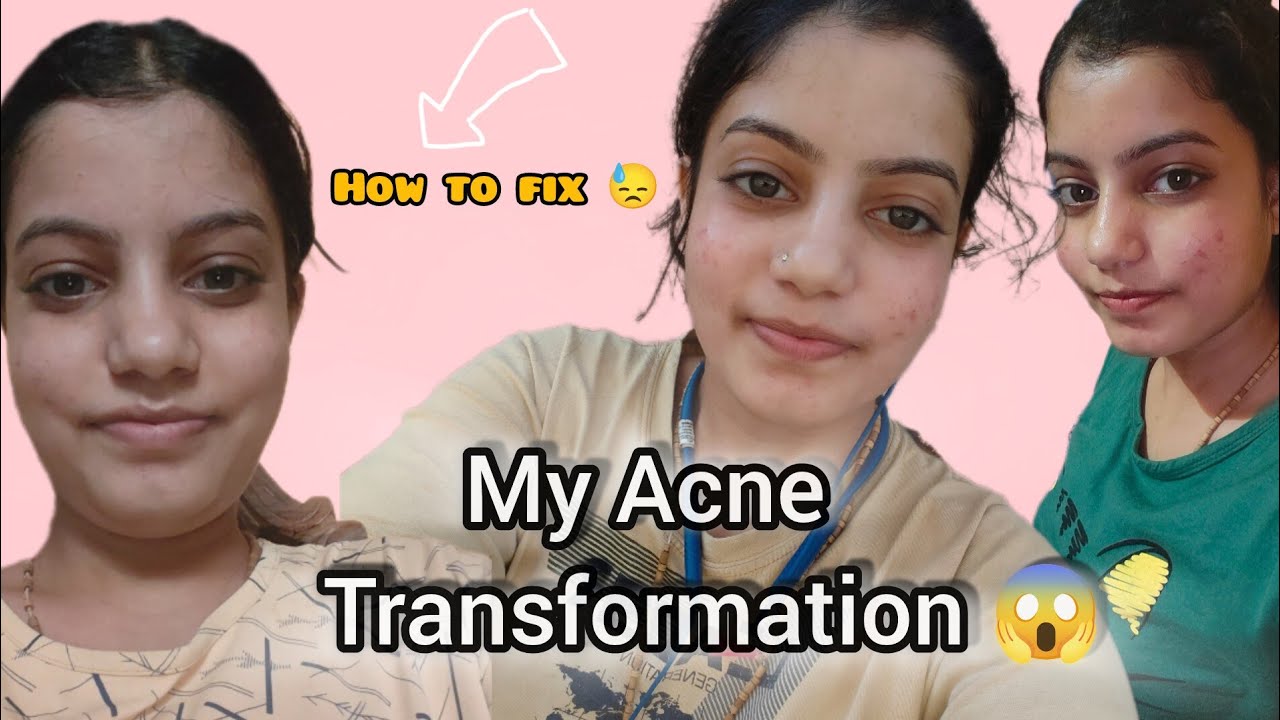 2023 में मुझे इतने PIMPLE कैसे ठीक हुए? | My Acne Journey 😭➡️✨