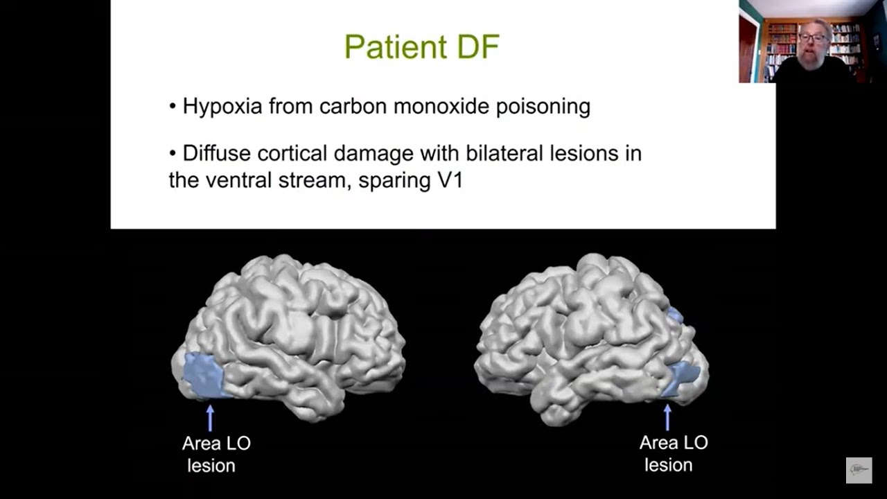 Mel Goodale: How DF and other single-cases have illuminated our understanding of the visual pathways