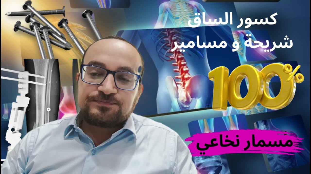 هل ممكن كسور عضمة القصبة تلتئم بالجبس و ايه هو مسمار نانسي ؟ (تركيب شريحة و مسمار نخاعي )  ٢٠٢٥