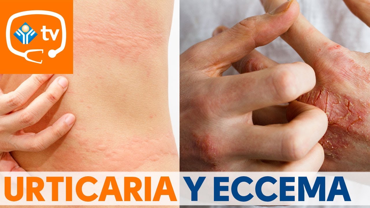 ¿Cuál es la diferencia entre eccema y urticaria?