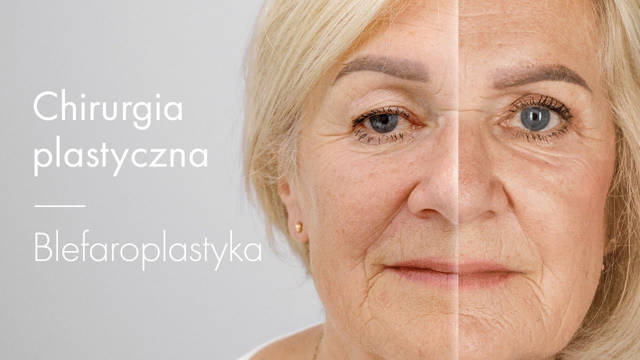 Plastyka powiek górnych – 