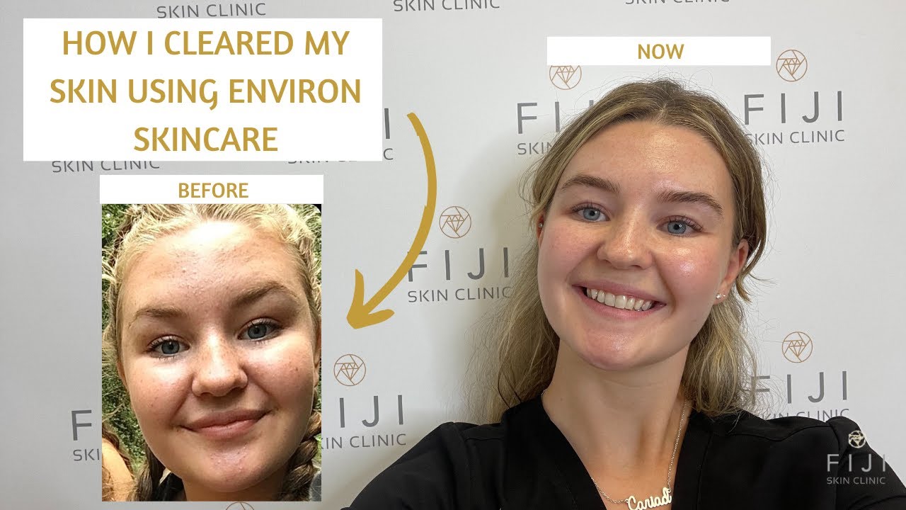 How I Cleared my Skin with Environ Skincare | Texture, Redness, Repairing Skin Barrier & Sensitivity