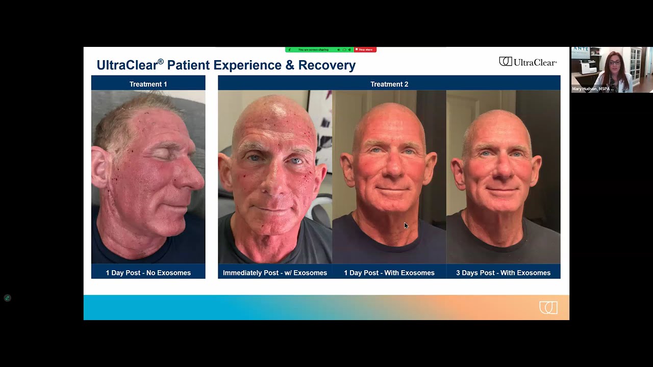 Introducing UltraClear® Laser Skin Rejuvenation | Avanté Medical Aesthetics