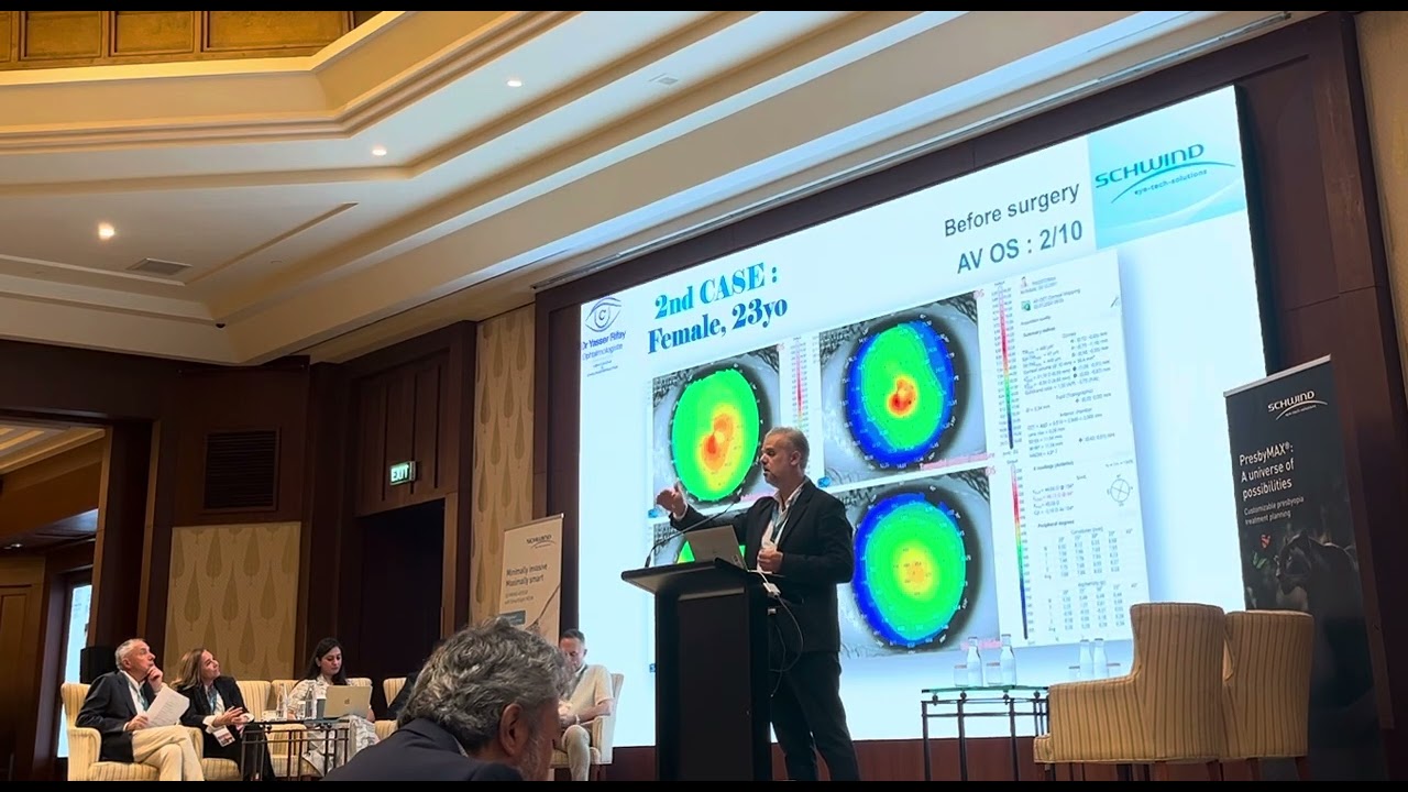 Schwind users meeting Bangkok : CW wavefront guided PRK in early keratoconus 