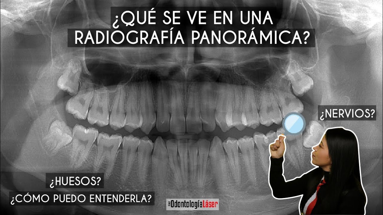 ¿Qué se ve en una radiografía panorámica? ¿Cómo puedo entenderla? 🦷 - Odontología Láser.