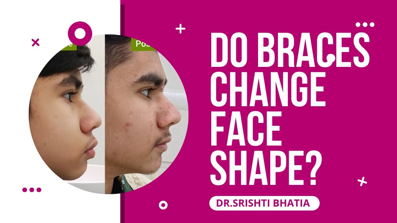 DO BRACES CHANGE FACE SHAPE? क्या ब्रेसेस से मु की शेप बदल जाती है? DR. SRISHTI BHATIA