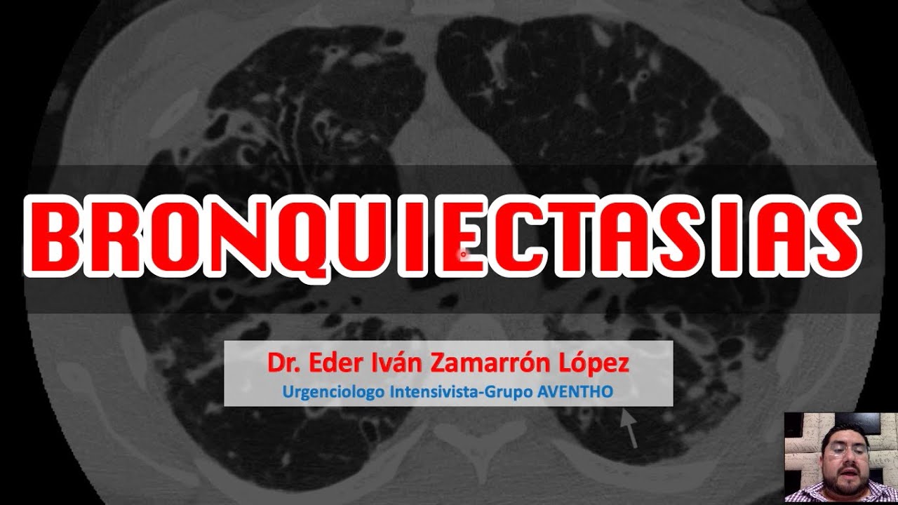 Bronquiectasias ICEST