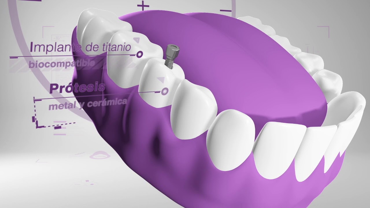 Implante dental unitario. DENTIX