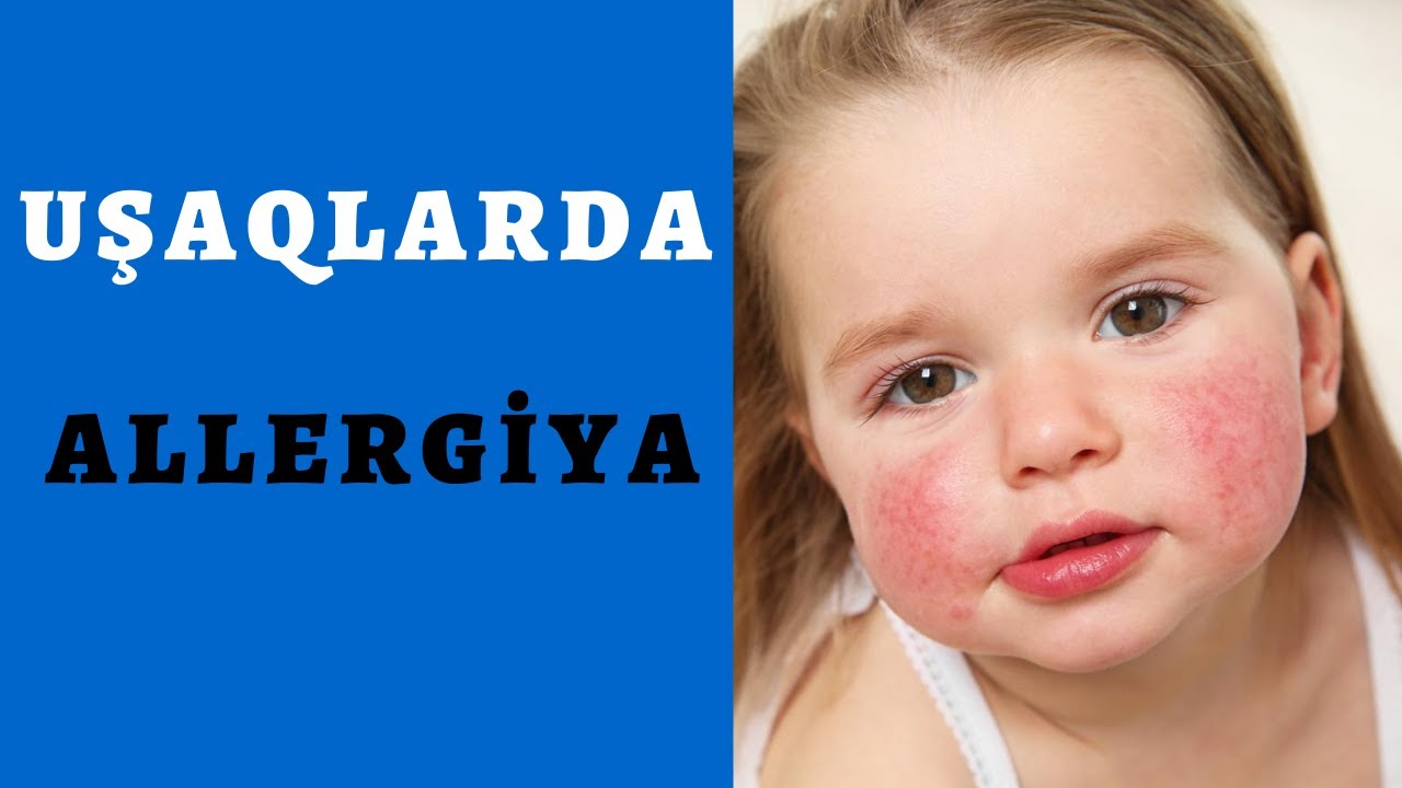 Uşaqlarda Allergiya. (simptomları,müalicəsi, allergiyanı necə önləmək olar?