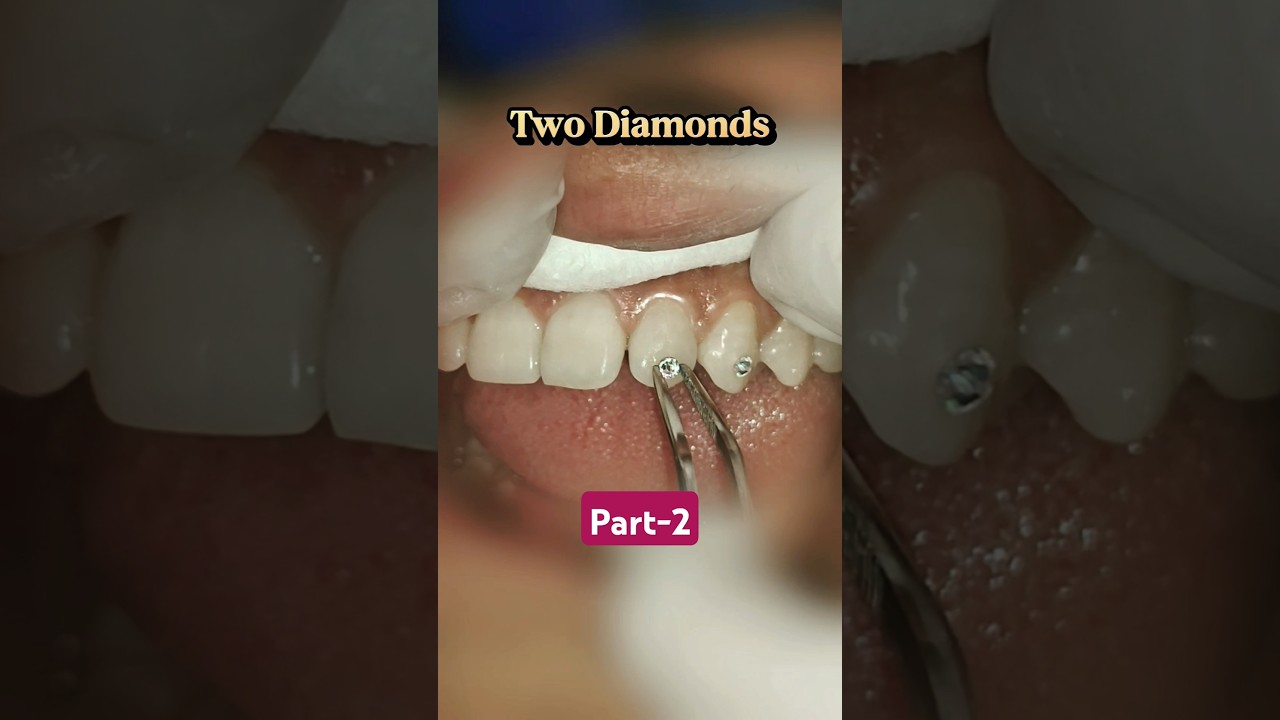 Two diamonds 💎💎👌 || Teeth gems/stones || dat ma diamond rakhne #teethdiamond #gems #stone #smile