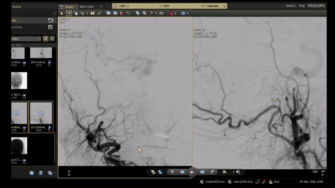 Case-2, Meningioma, 09-03-2026