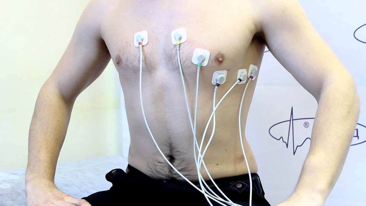Самостоятельное наложение ЭКГ-электродов