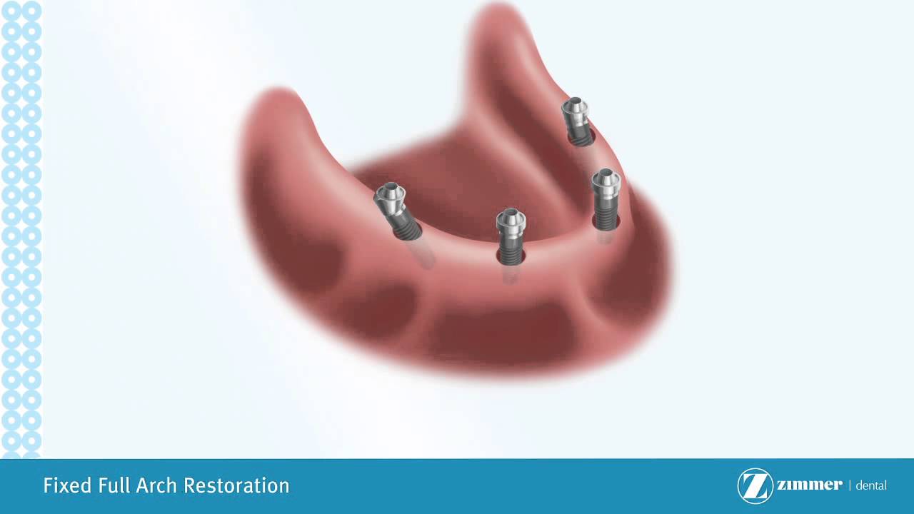 Introduction to Hybrid Implant Dentures