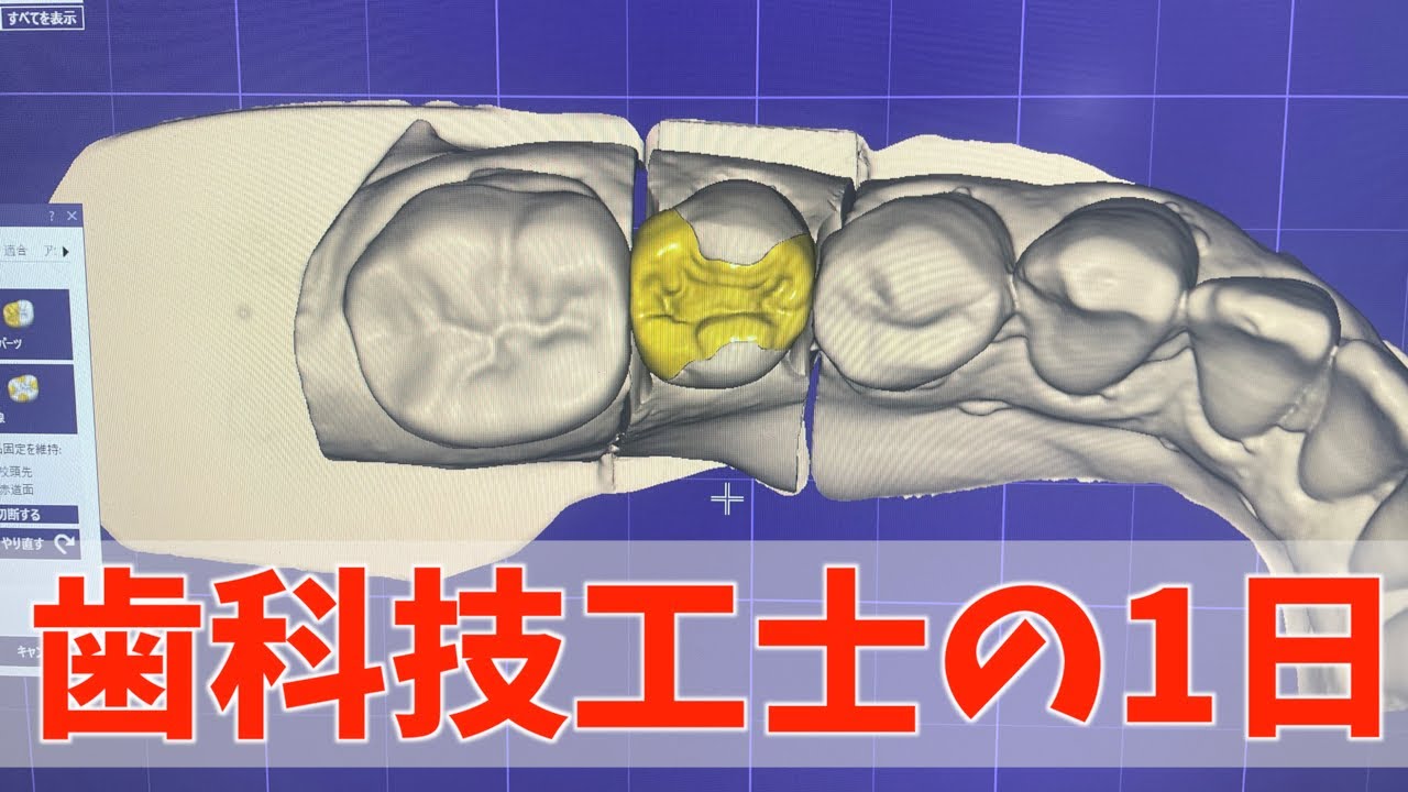 CADインレーめちゃ多い