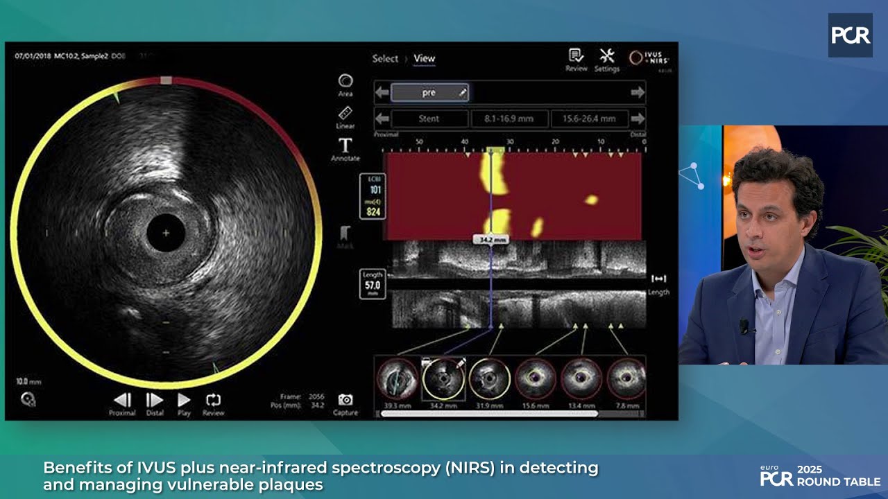 How NIRS + IVUS help you see the unseen