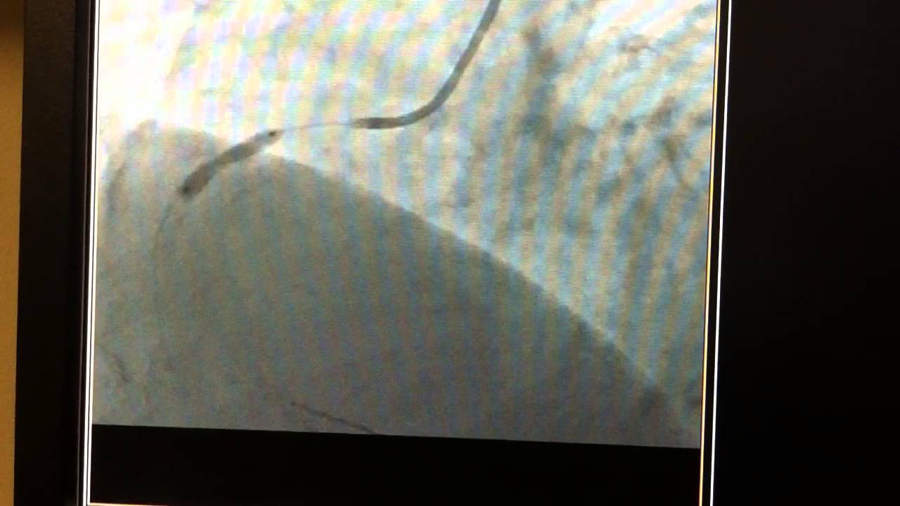 Trans-Radial Coronary Intervention of RCA lesion by Dr. Sanjay Patel in Acute Inferior Wall MI