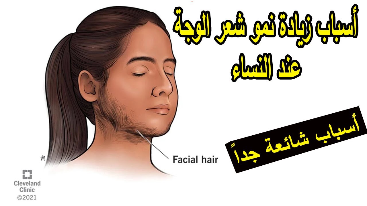 أشهر أسباب زيادة نمو شعر الوجه عند النساء و طرق العلاج