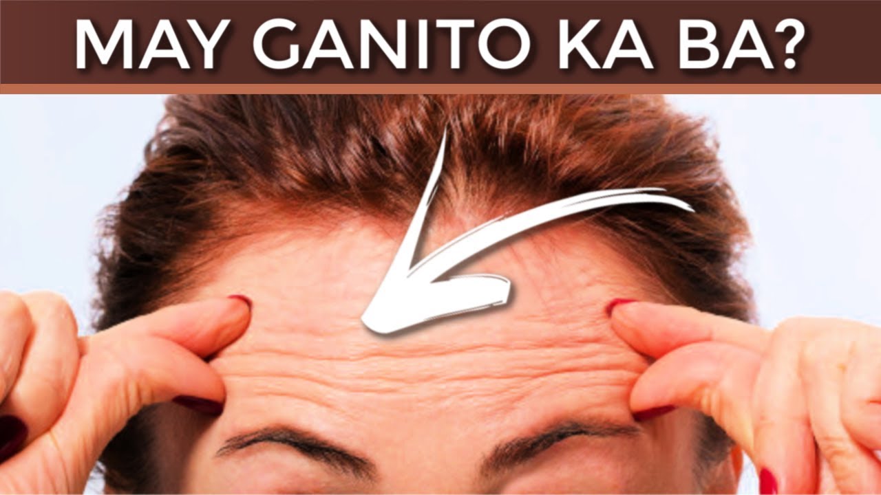 Meron ka bang Swerteng LINYA sa Iyong NOO? &ndash; Alamin ang Kahulugan Nito
