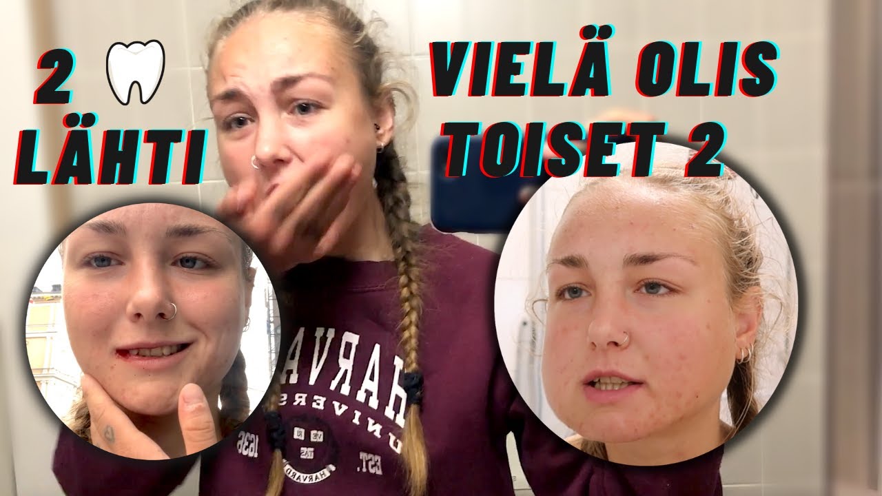 Viisaudenhampaiden poisto | OSA 1