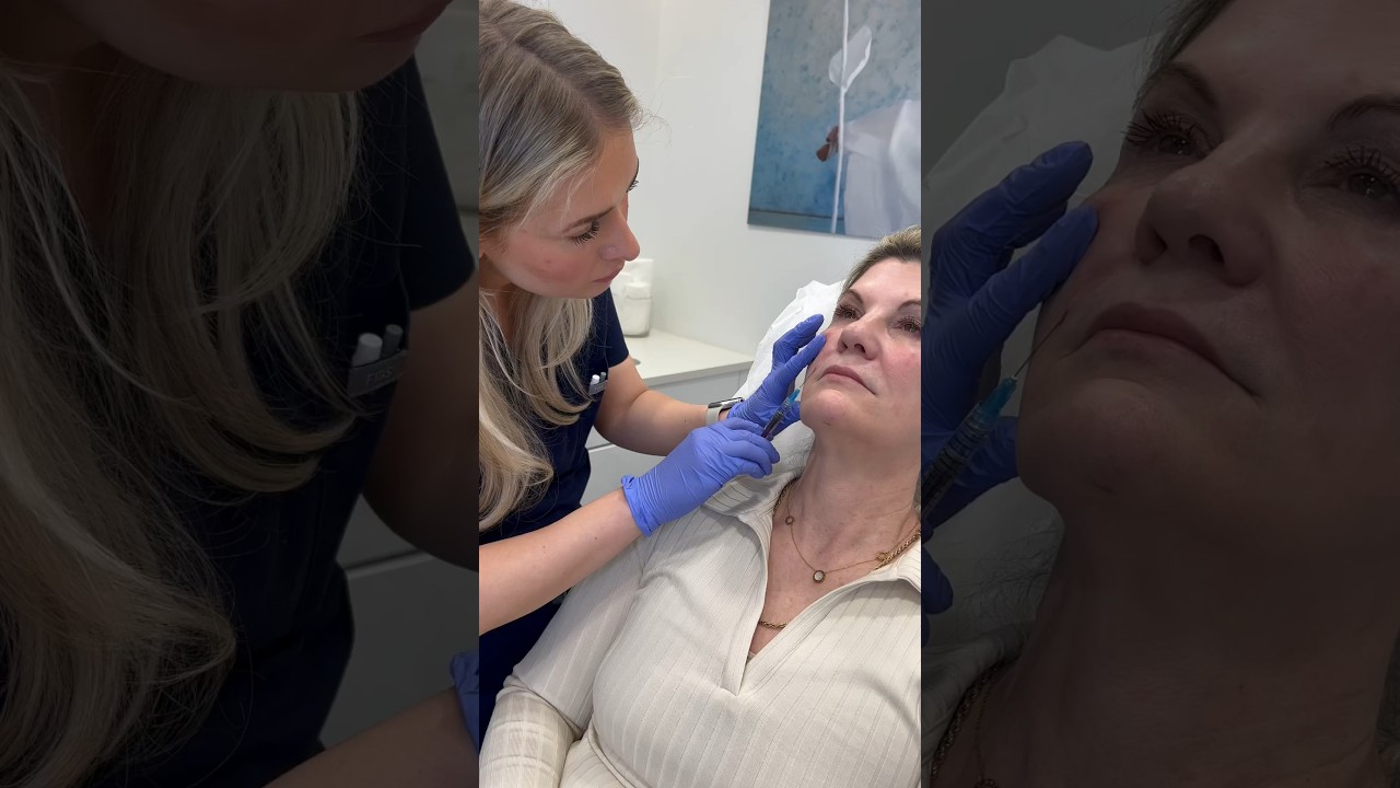 Smile line filler 💉🤍 #medicalaesthetics #lipfiller #skincare