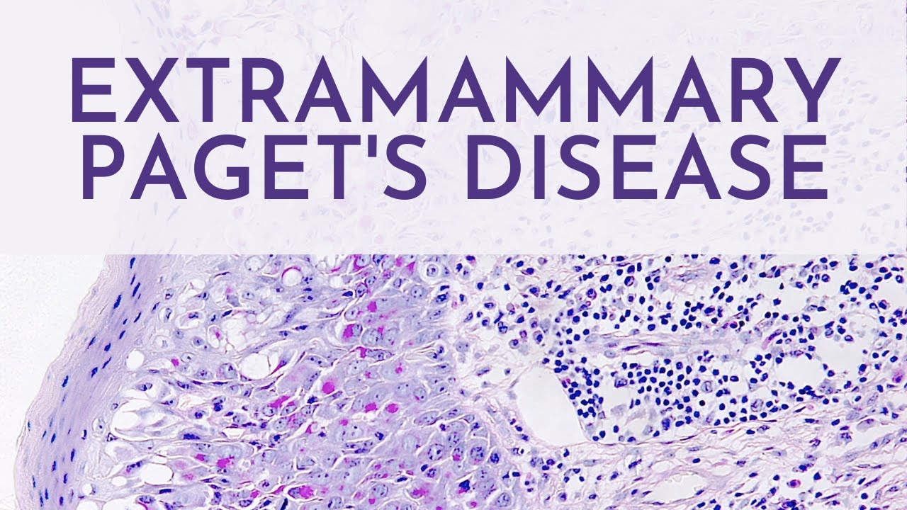 Extramammary Paget's Disease - Pathology mini tutorial