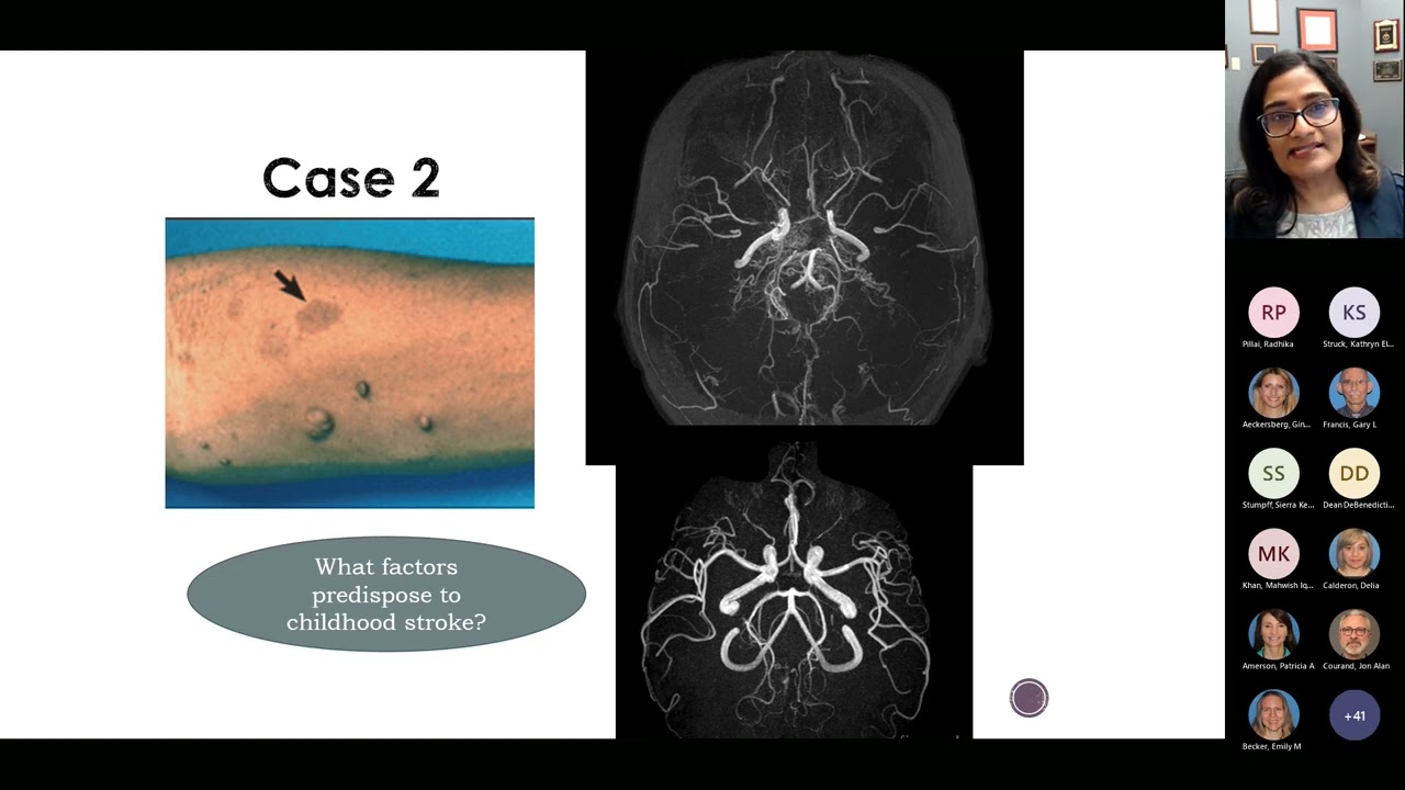 Pediatric Strokes: 6 Illustrative Cases and Insights | Lalitha Sivaswamy, MD