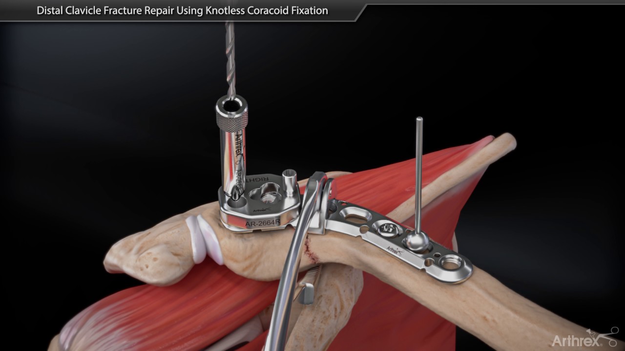 Восстановление перелома дистального отдела ключицы с использованием клювовидной фиксации