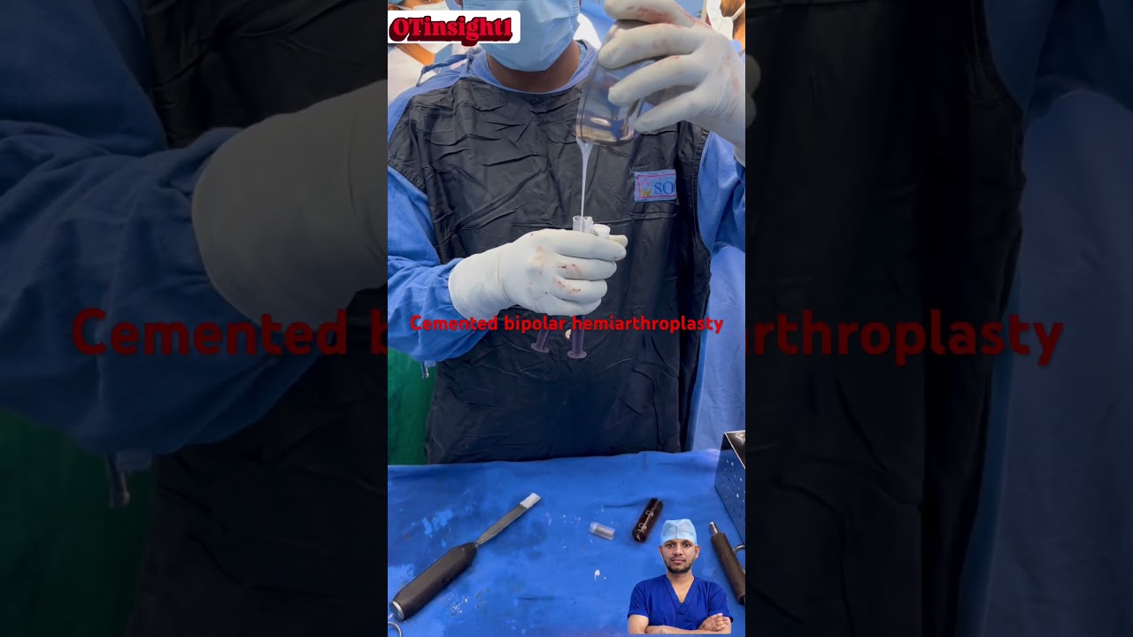 Bipolar hip replacement surgery for fracture neck of femur.#HipReplacement #OTInsights1