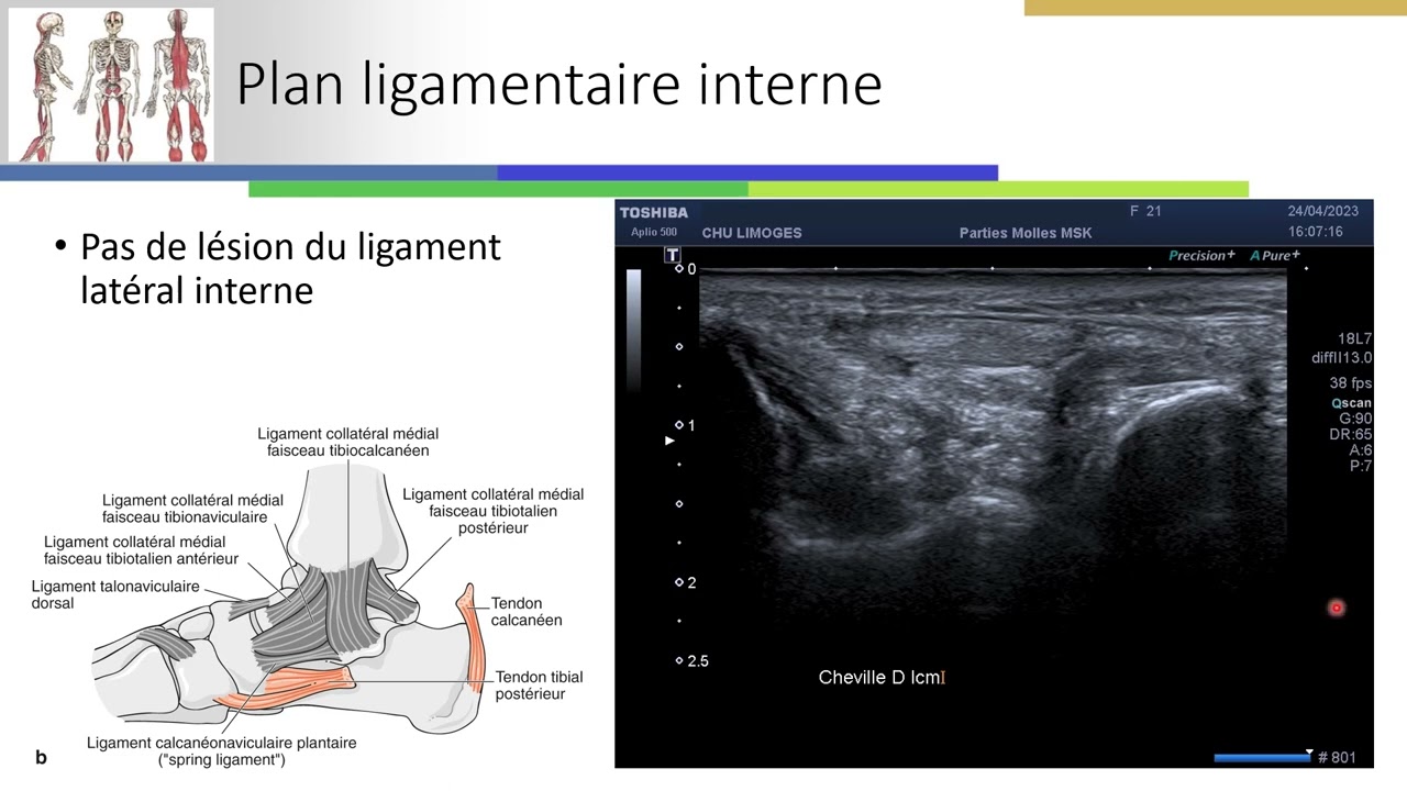 Entorse calcanéo-cuboïdienne (chopart externe)