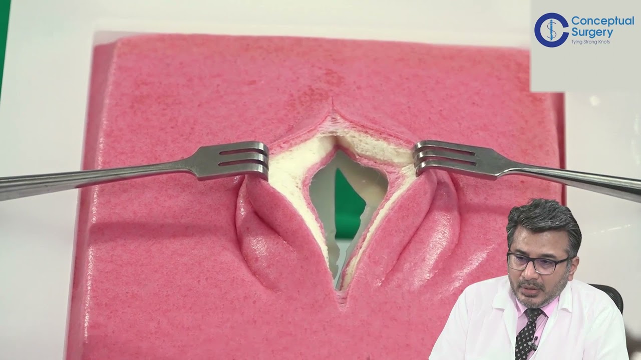 Laparotomy Closure Dr. Jignesh Gandhi