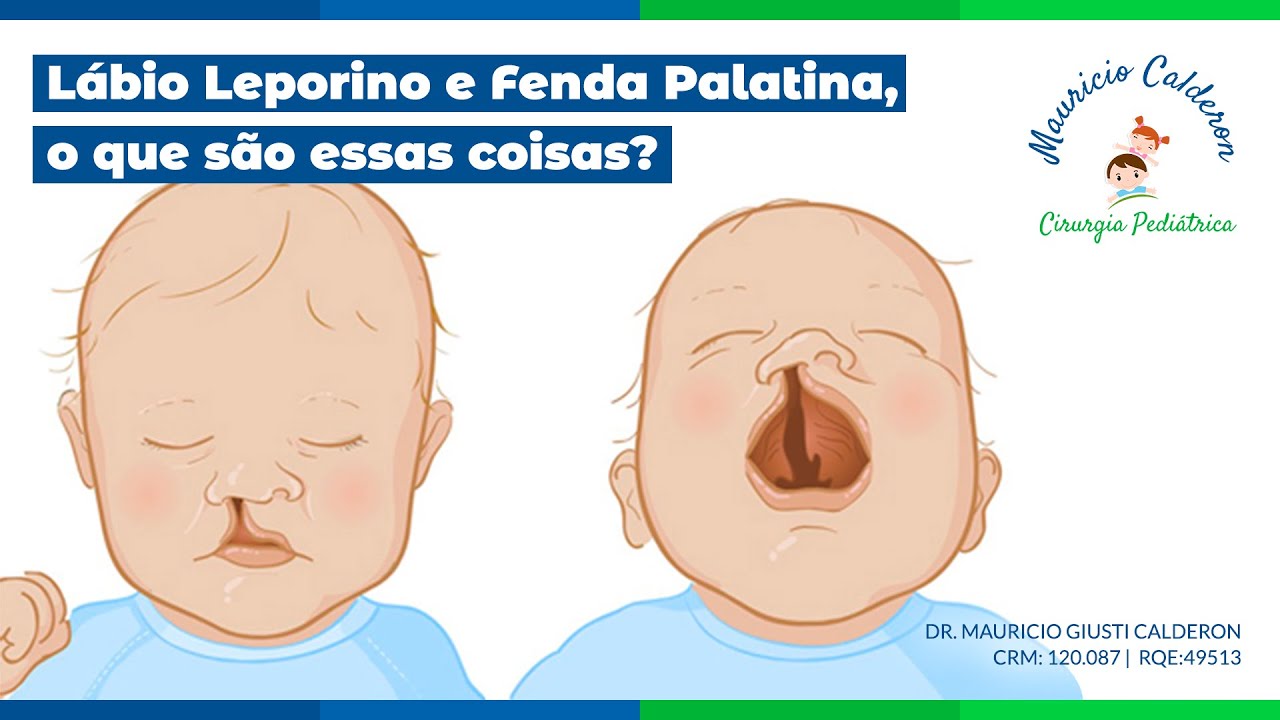 Cirurgia Infantil Channel | Lábio Leporino e Fenda Palatina, o que são essas coisas?