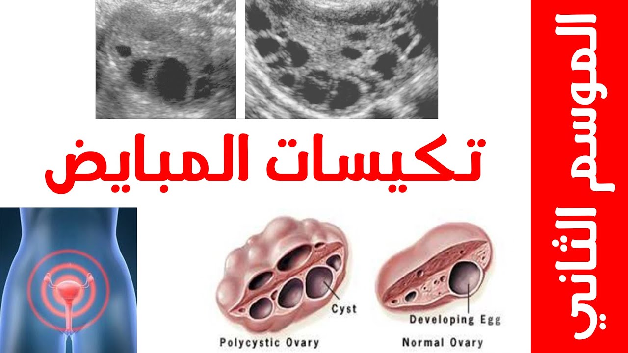مرض تكيسات المبايض الجزء الأول - الحلقة الأولى - الموسم الثاني - د. أحمد حسين