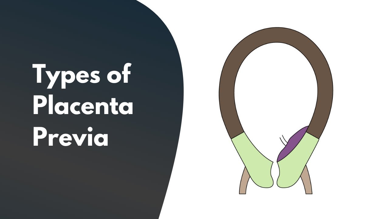 Types of Placenta Previa