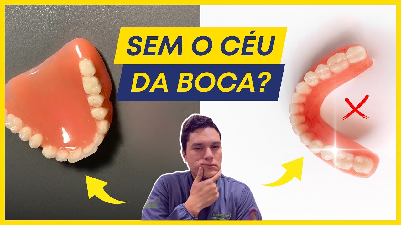 PRÓTESE SEM O CÉU DA BOCA É POSSÍVEL? (A VERDADE).