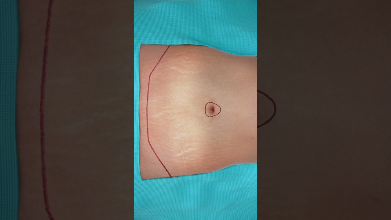 Tummy Tuck Simulation - Watch Step by Step How It Happens! #tummytucksurgery