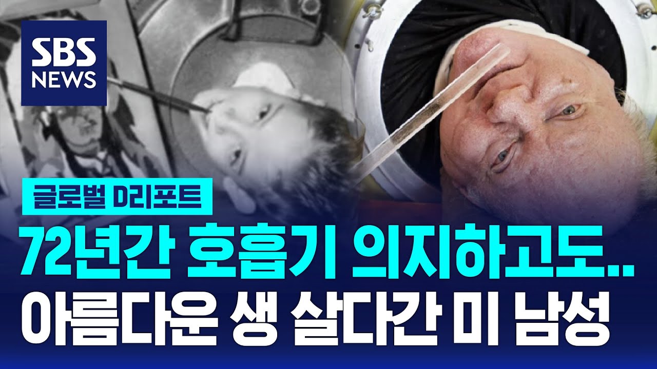 72년간 '아이언렁' 호흡기 의지한 美 남성 별세 / SBS / #D리포트
