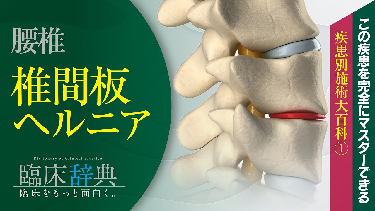 【腰椎椎間板ヘルニアの病態を完全網羅！】なぜヘルニアは『飛び出している方』が早く治るのか？ヘルニアのパラドックスを徹底解説！！