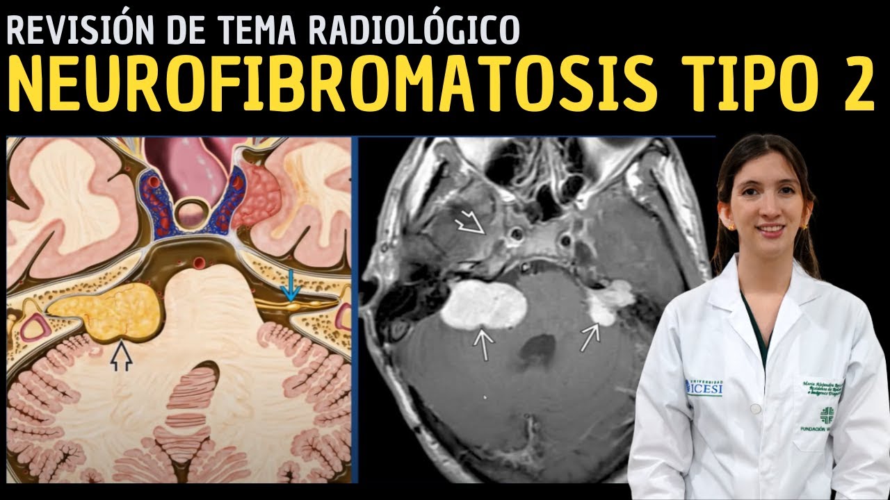 Revisión de Tema 92: Neurofibromatosis Tipo 2.